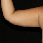 Upper Arm Liposuction - Case #1 After
